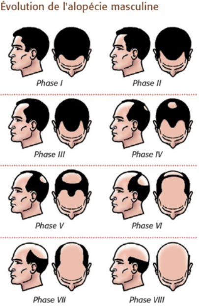 évolution de la calvitie